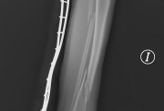 Hueso con rotura- Osteogénesis Imperfecta - Rare Commons